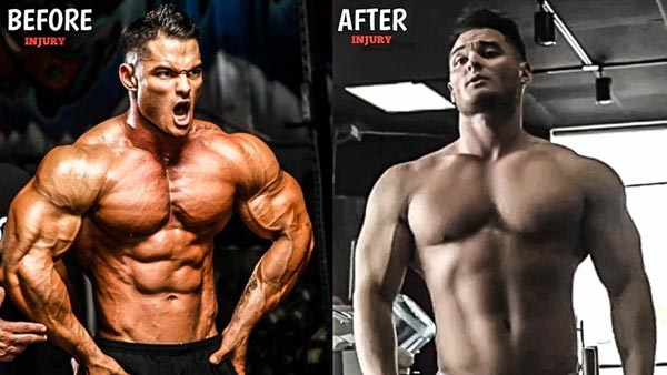 Calum Von Moger Before And After Injury
